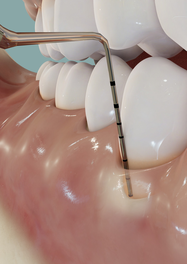 Parodontologie, clinica Dental Friends
