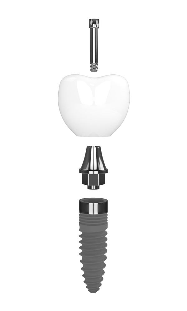 Implantologie, implant dentar, clinica Dental Friends
